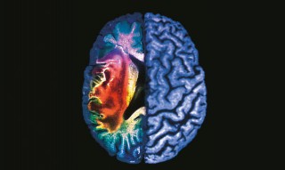 L’Ospedale di Pescara capofila nella lotta all’ictus